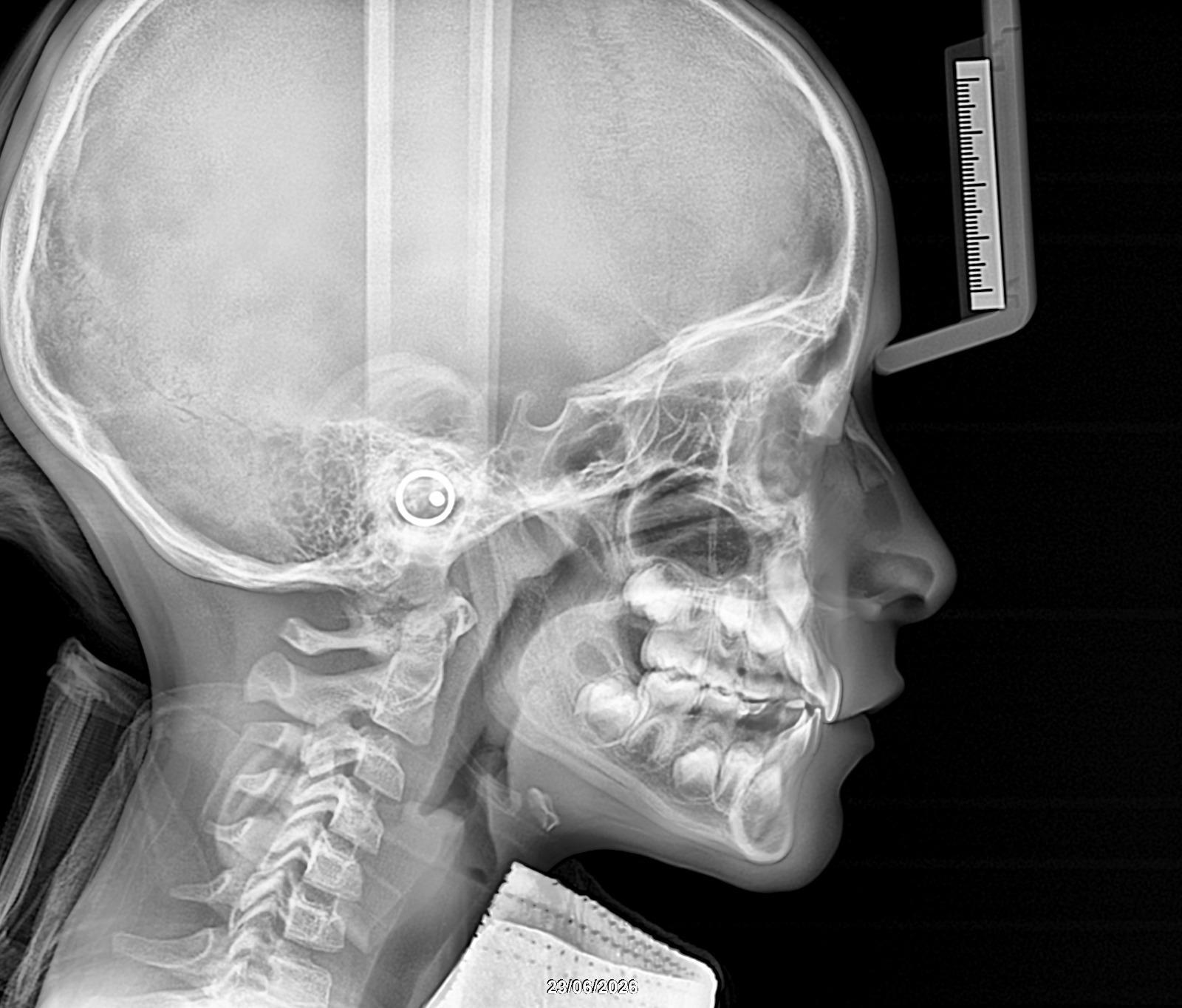 Radiografía de perfil para cefalometría