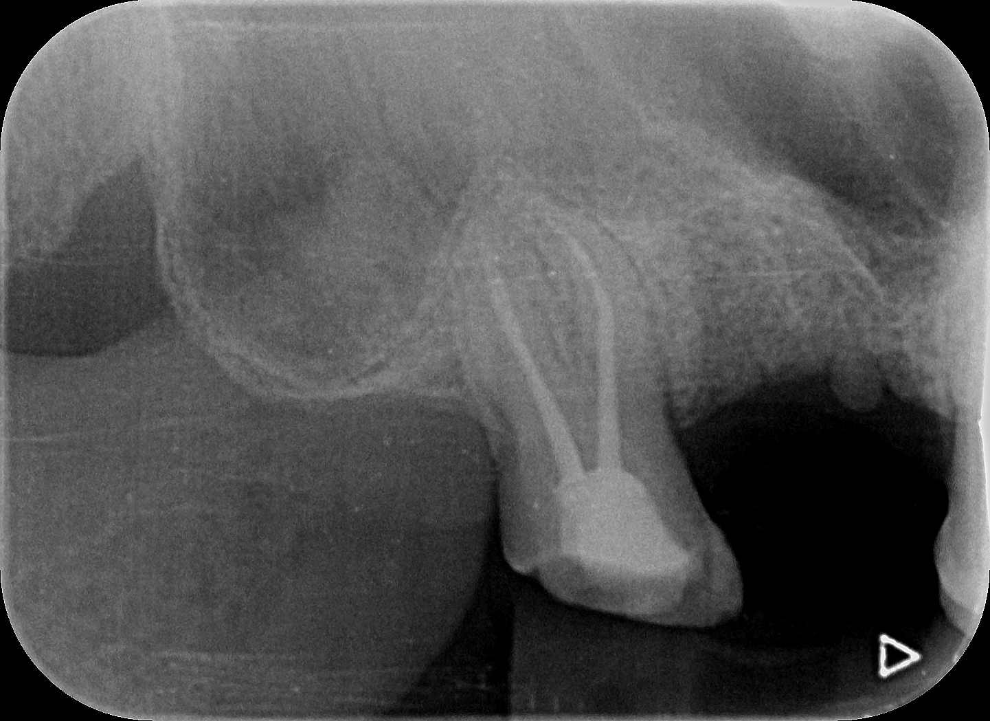 Radiografía periapical de control