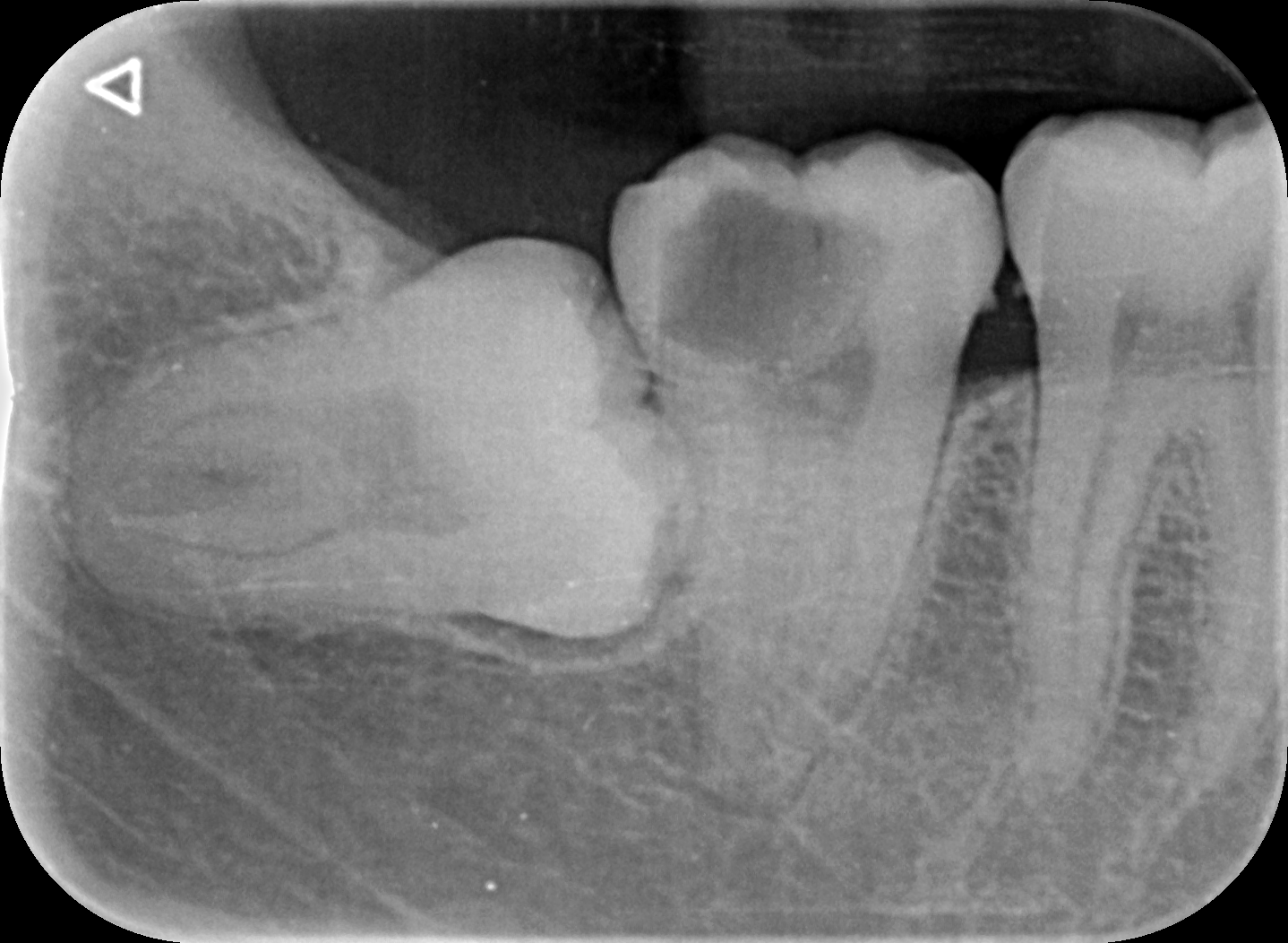 Radiografía periapical dental