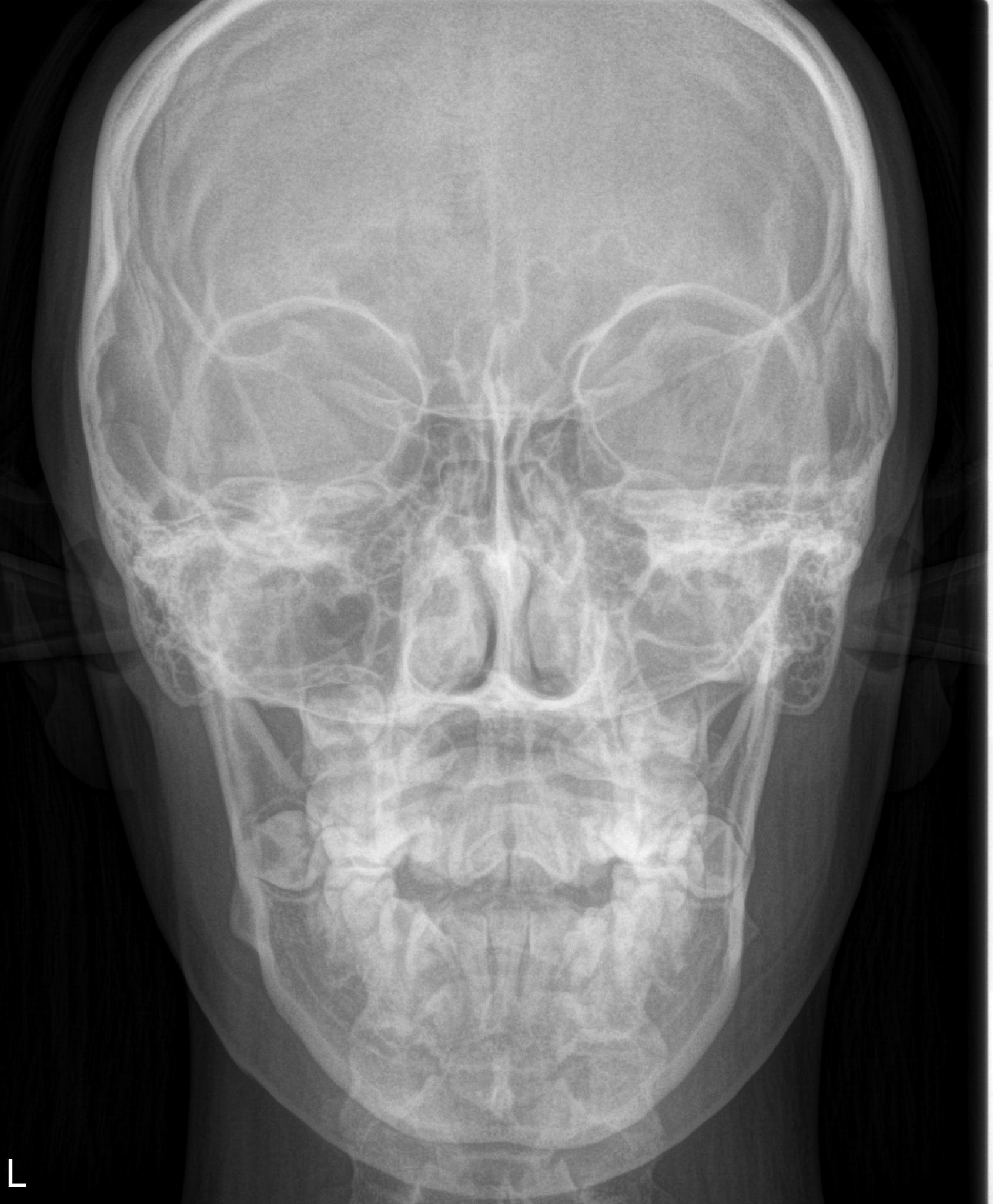 Radiografía posteroanterior