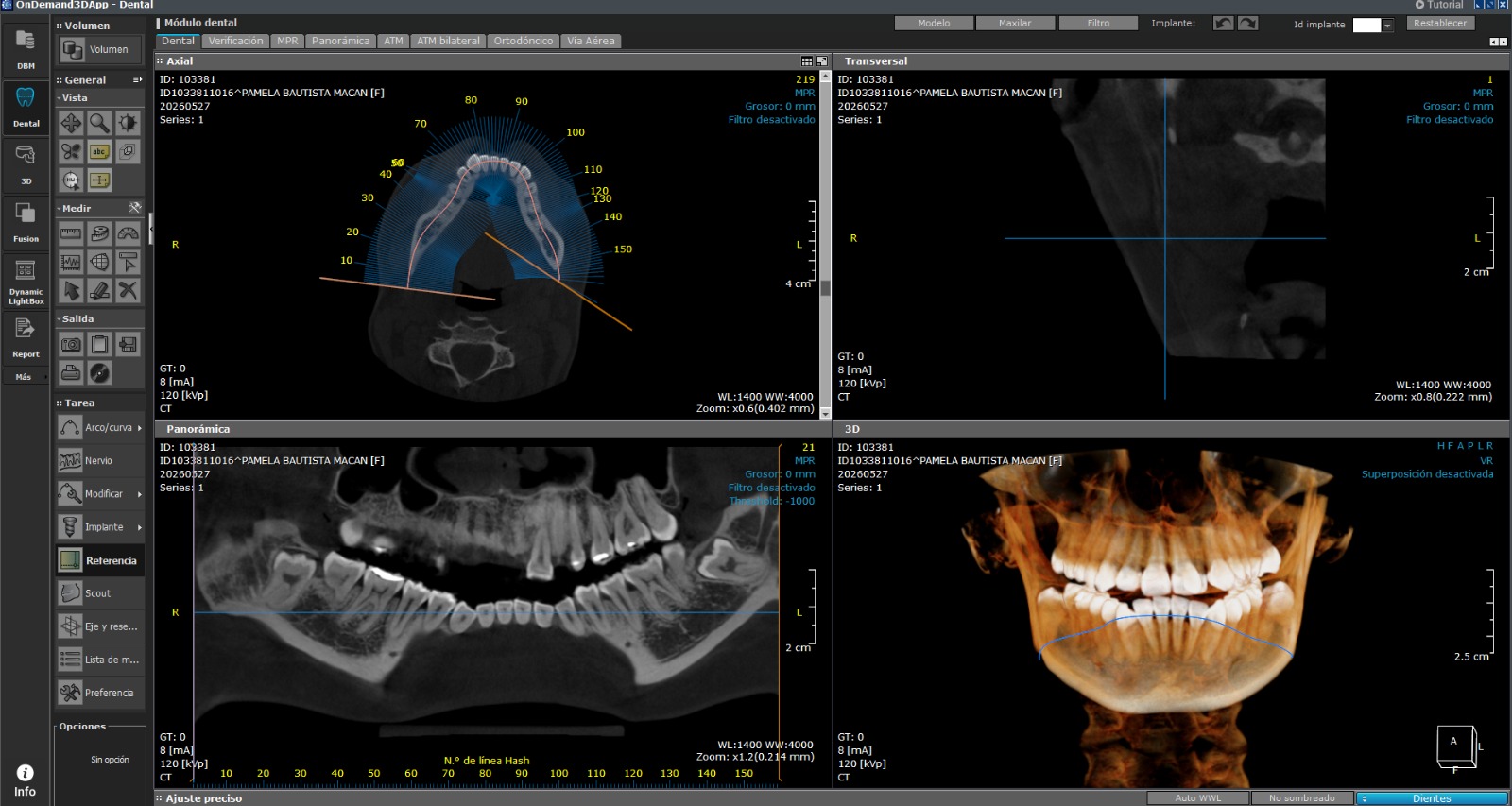 Tomografía computarizada 3D Cone Beam